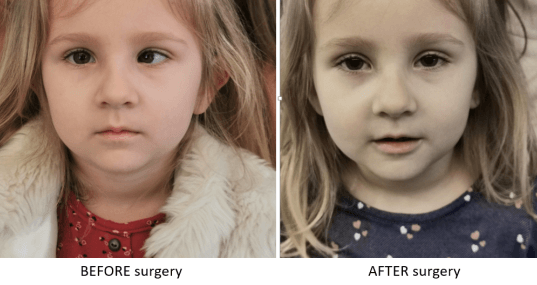 strabismus surgery