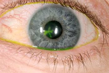 eye diseases