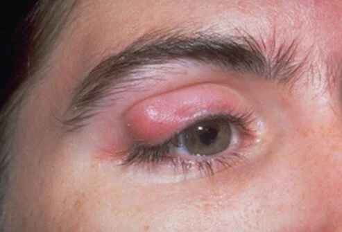 eyelid infections