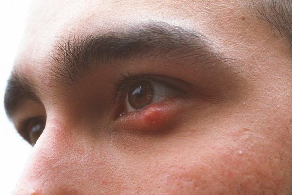 eyelid infections with lash