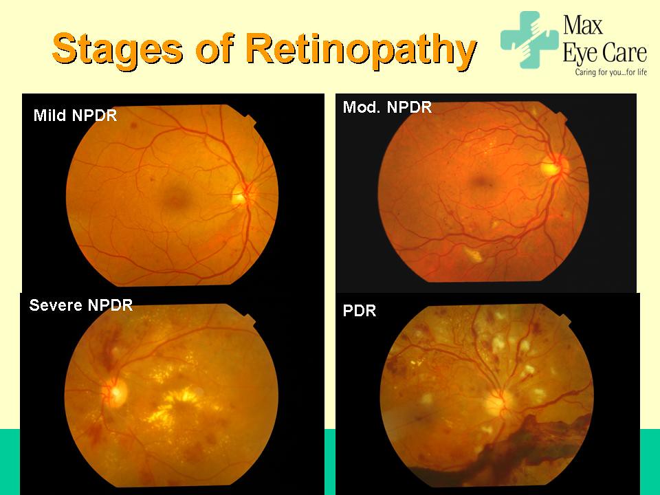 stages of diabetic retinopathy