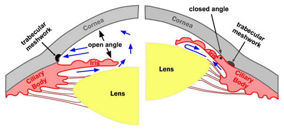 understanding narrow angle glaucoma