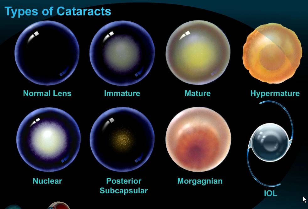 cataract- formation and classification