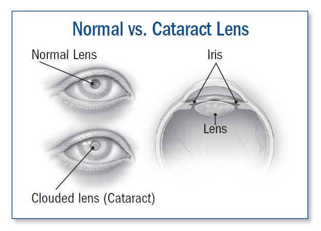Cataract- formation and classification