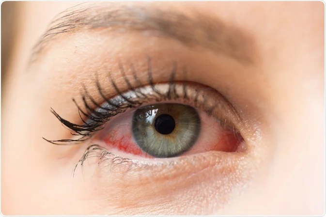 eye allergies and infections