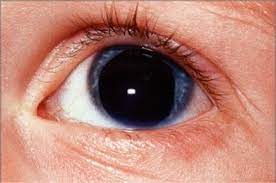 10 rare congenital and genetic eye disorders