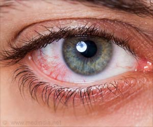 contraindications for contact lens
