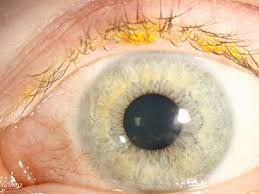 Ocular surface disease