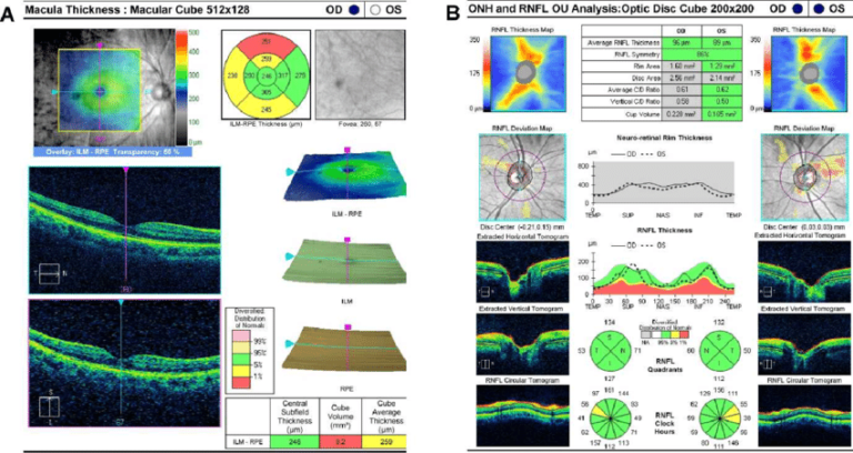 Optical coherence topography (OCT)- things you need to know