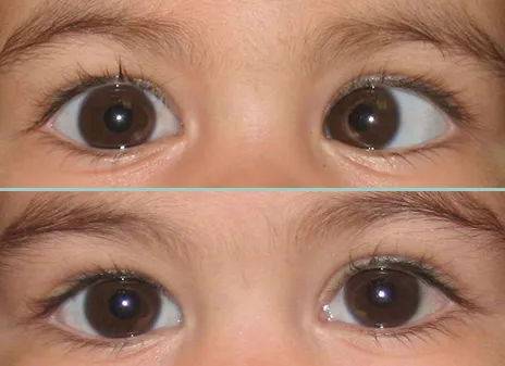 intermittent exotropia
