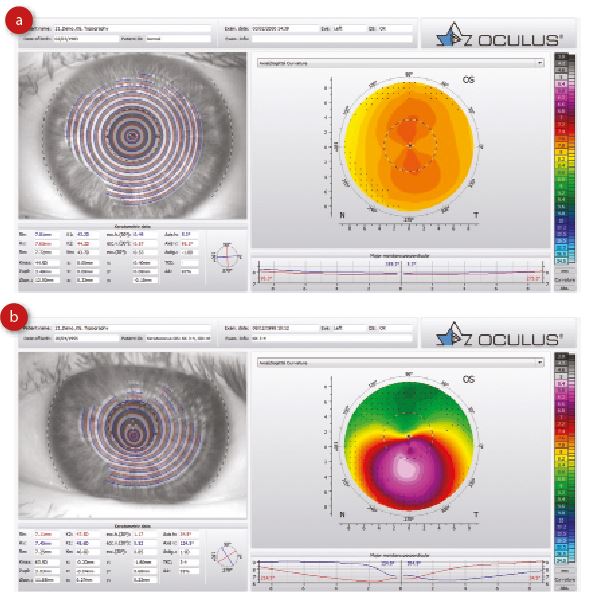 refractive surgeries