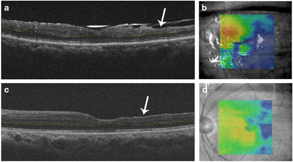 retinal thinning